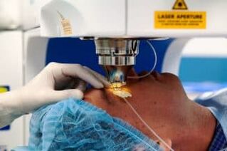 Laser vision surgery